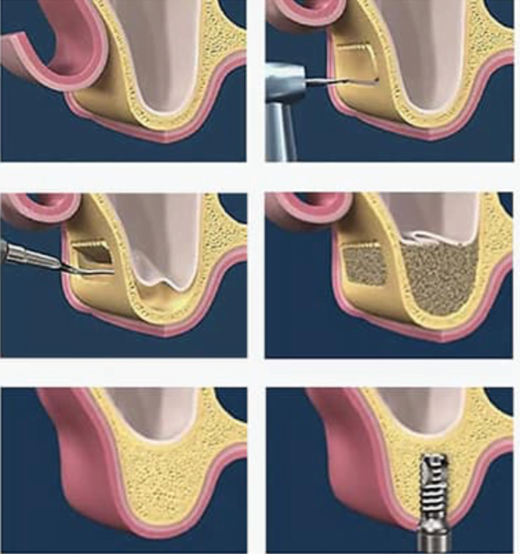 Chirurgie Pr Implantaire Et Implantaire Cabinet Ido