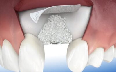 Tout savoir sur la greffe osseuse